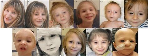 Jun 25, 2021 · annals of vascular surgery: Facial features of six LIG4 cases with microcephalic ...