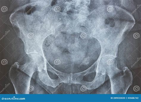 Hip Xray Human Skeleton Pelvis And Femur Bone Osteoporosis Stock