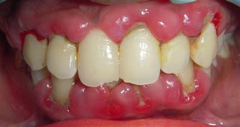 Treated Cases Gingivectomy Restore Dental Treatment Centre Rajkot