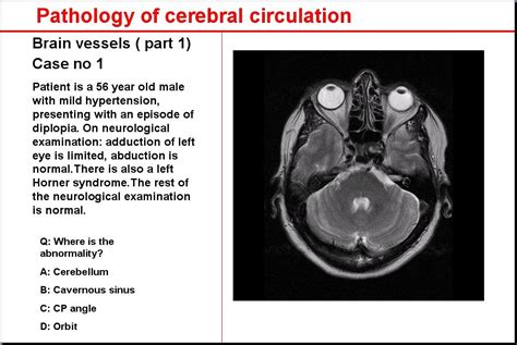 Ucla Neurovasculature Web Atlas Anatomy Study Ucla Cerebral Circulation