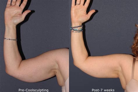 Arm Contouring San Diego Ca Cosmetic Laser Dermatology