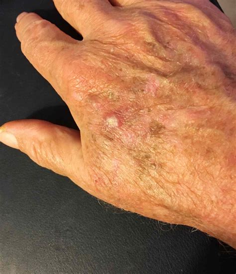 What Does Squamous Cell Carcinoma Look Like