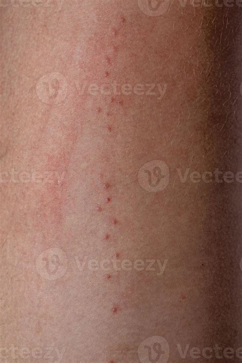 Allergic Reactions To Tick Bites 9231295 Stock Photo At Vecteezy