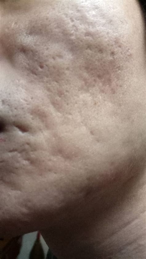 Can Tretinoin Still Be A Feasible Tropical Product To Treat Such Acne