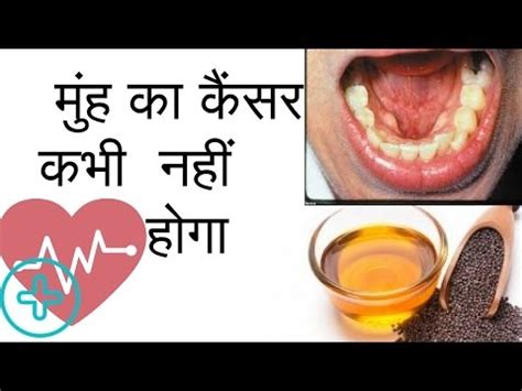 गले के कैंसर का उपचार gale ke cancer ka ilaj in hindi. Muh Ke Cancer Ka Ilaj | मुंह का कैंसर | Mouth Cancer ...