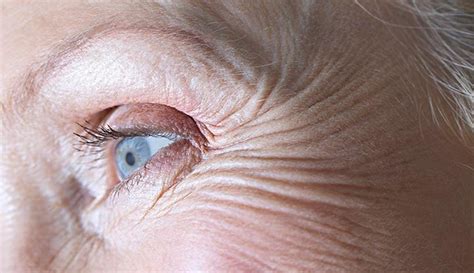 Crows Feet What It Is Botox Treatment And Prevention