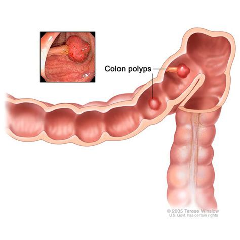 A colon often precedes an explanation, a list, or to introduce a quoted sentence. Colon Polyps | NIDDK