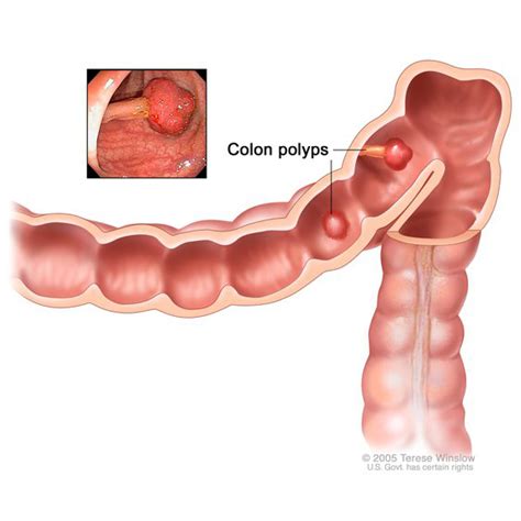 The colon is the final part of the digestive tract. Colon Polyps | NIDDK