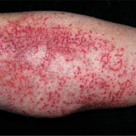 Diffuse Erythematous Purpuric Papules Partly Confluent In A Linear Or