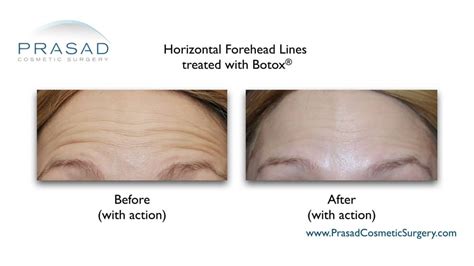 How To Get Rid Of Forehead Wrinkles Dr Amiya Prasad Blog