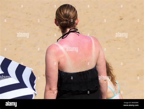 Sunburn Back High Resolution Stock Photography And Images Alamy