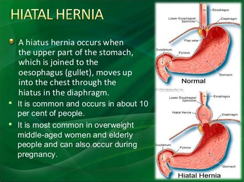 Hernia Yashwant Kumar