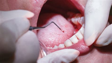 Steps To The Nonsurgical Treatment Of Periodontitis