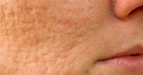 The What Why And How Of Acne Scarring My Skin And Body Clinic