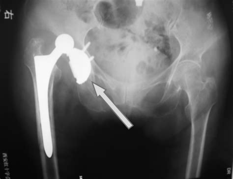 Causes And Solutions Of Primary Hip Replacement Failure