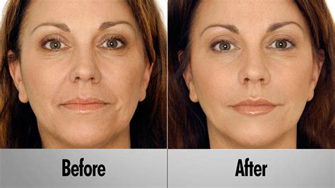 Vampire Facelift Look Babeer Without Surgery Or Downtime