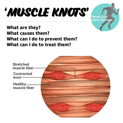How To Prevent Knots In Muscles Killexhibition Doralutz