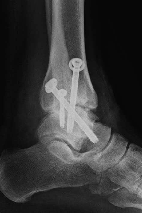 Arthroscopic Ankle Arthrodesis With Intra Articular Distraction The