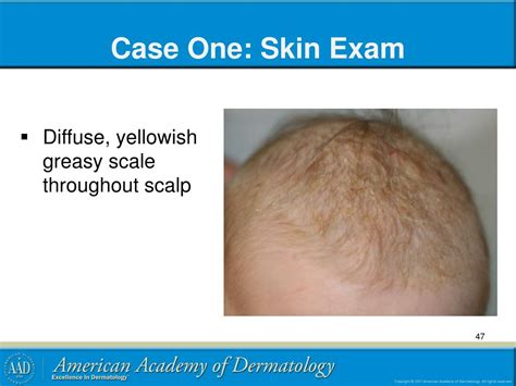 Ppt Pediatric Cutaneous Fungal Infections Powerpoint Presentation