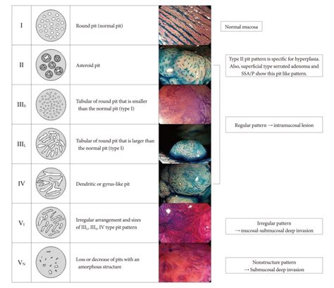 Pit Pattern Classification Of Colorectal Neoplasia Adapted From Tanaka