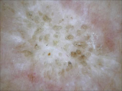 Dermoscopy Of Extragenital Lichen Sclerosus Dermatology Jama