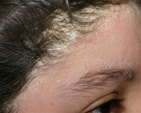 Seborrheic Dermatitis Dermatology Care Of Charlotte Off