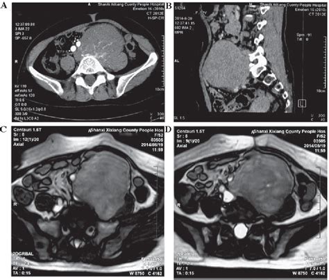 Figure 1 From Preoperative Management Of Giant Retroperitoneal