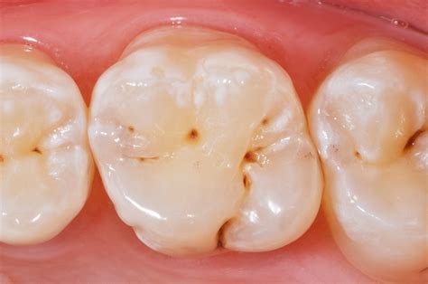 Self Etching Primer On Chrome Plastic - Black Etching Primer