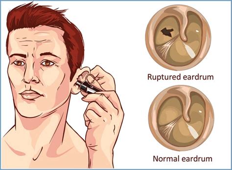 Tympanoplasty Ear Drum Repair Yellowstone Surgery Center