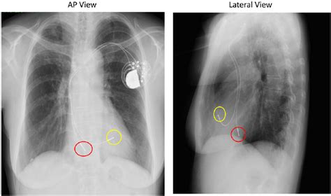 Chest Radiograph Of A Dual Chamber Pacemaker Recipient The Atrial Lead