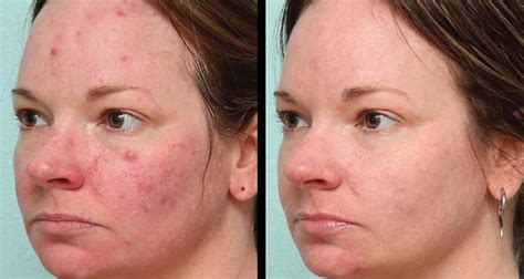 Forever Clear A New Science For Acne Sufferers Saphira Clinic