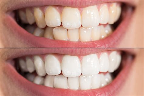 Teeth Whitening Fraser Dental Hobsonville Auckland