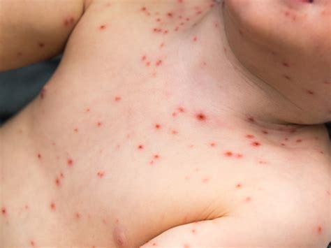 Chickenpox Parties May Be Life Threatening A Pediatrician Warns