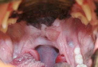 Maybe you would like to learn more about one of these? Tonsilectomy - Pre | The tonsils are inflammed and causing ...