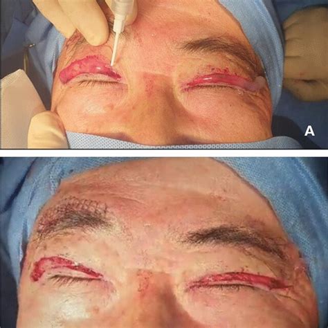 Photographs Of A Patient Who Underwent Surgery For Blepharoptosis A