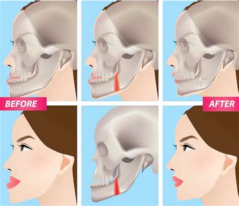 Alignment Of The Jaw With Orthognathic Surgery
