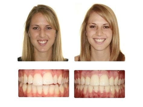 Before And After Invisalign West Chester Dental Arts 403 N Five Points Road West Chester Pa