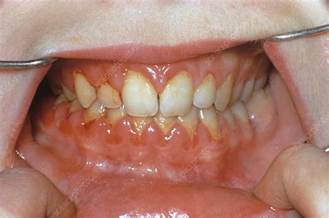Bleeding In Gum Disease Stock Image C0235735 Science Photo Library