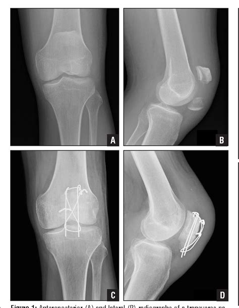 Figure 2 From Current Treatment Strategies For Patella Fractures