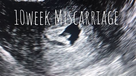 Miscarriage At 10 Weeks Tmi Photos Youtube