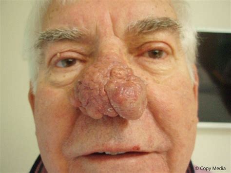 Retired Business Manager Had Life Changing Surgery On His Nose After It