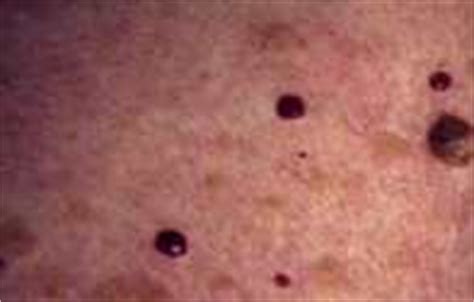Select from premium angioma of the highest quality. cherry angiomas pictures