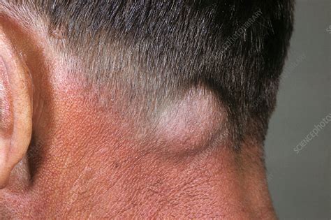 The signs and symptoms are numerous, all illustrating the interdependence of the homeostatic mechanisms, which, when not functioning properly, provide the. Secondary lymph node cancer - Stock Image - C029/4616 ...