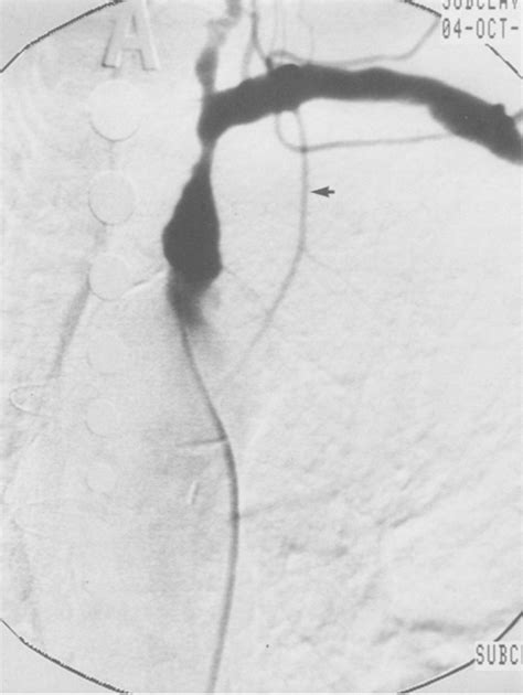 Figure 1 From Recurrent Coronary Subclavian Steal Syndrome Treated By