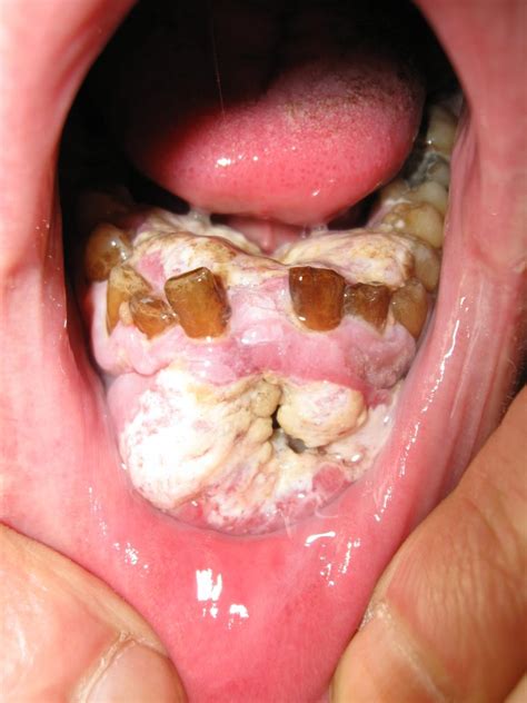 Normal Roof Of Mouth Photos