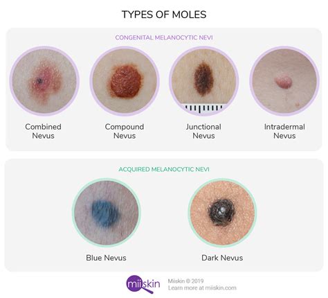 Skin Mole Types