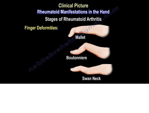 Rheumatoid Arthritis Of The Hand —