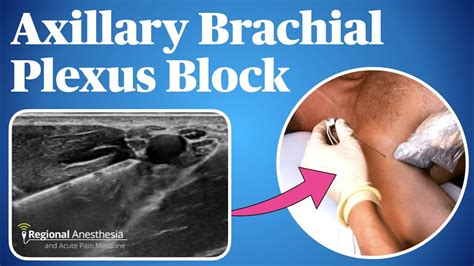 Axillary Brachial Plexus Block Youtube