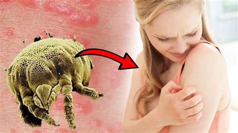 How To Get Rid Of Scabies At Home Natural Home Remedy Youtube