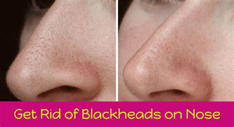 When pores get clogged, it often results in closed comedones, or comedo. How to Get Rid of Blackheads on Nose Fast - eMARASH